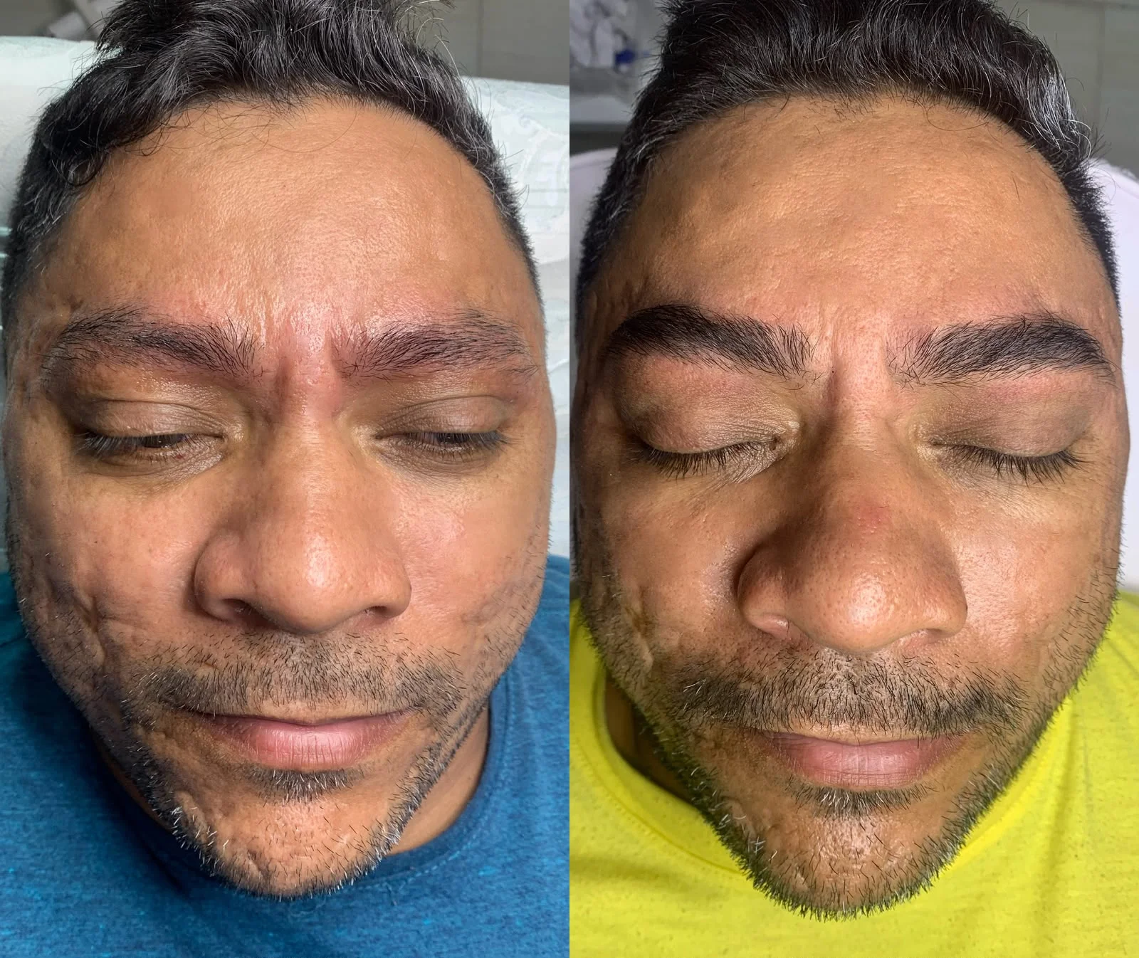 Resultado — Regeneração de Sobrancelhas masculino