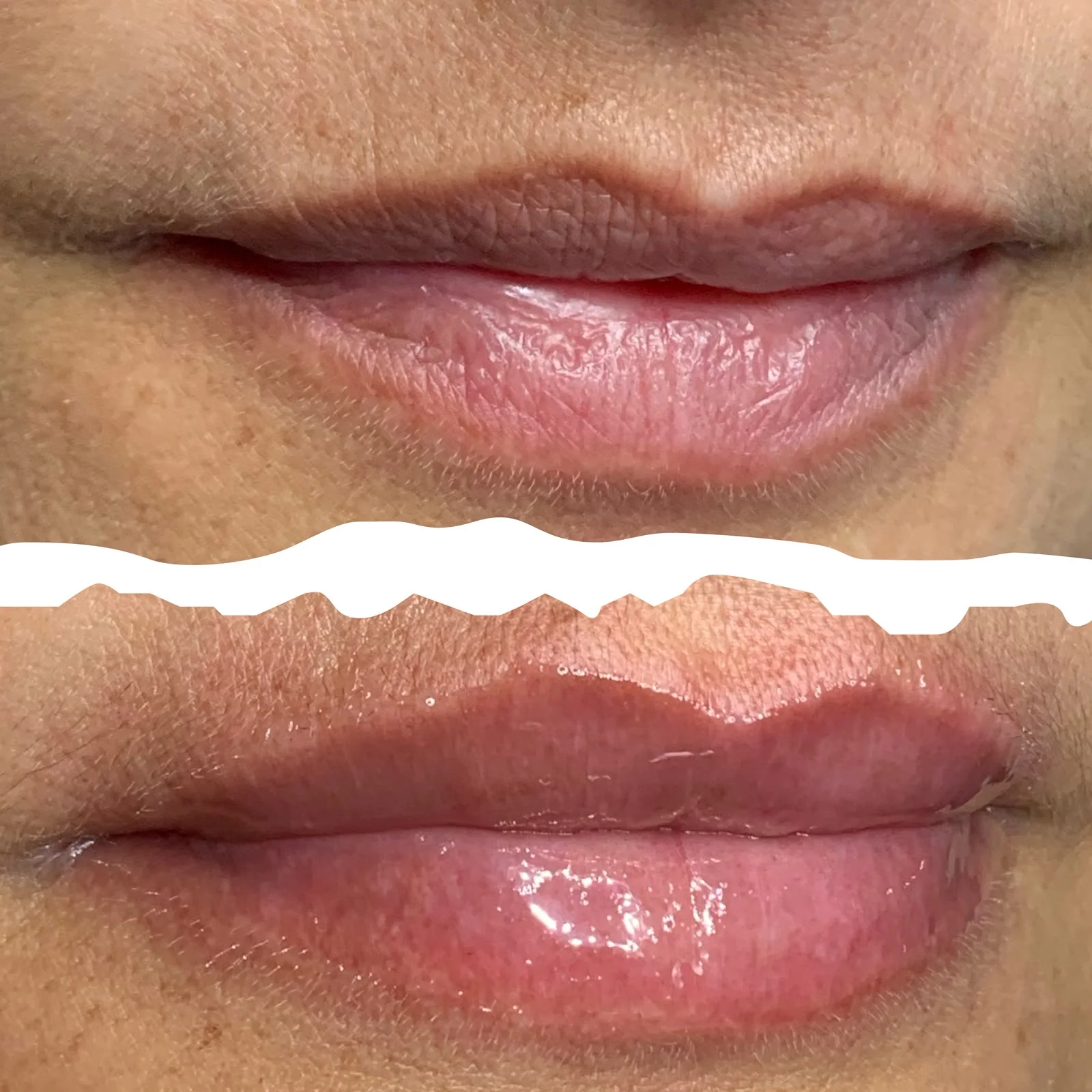 Resultado — Revitalização Labial